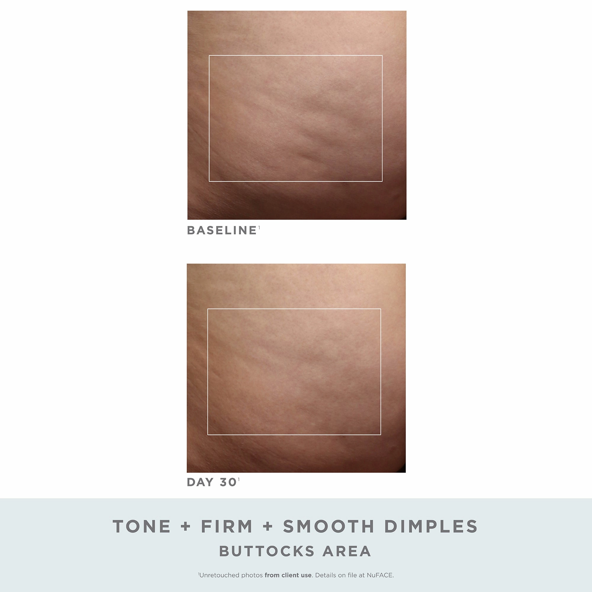 Nuface Nubody Toning And Firming Kit