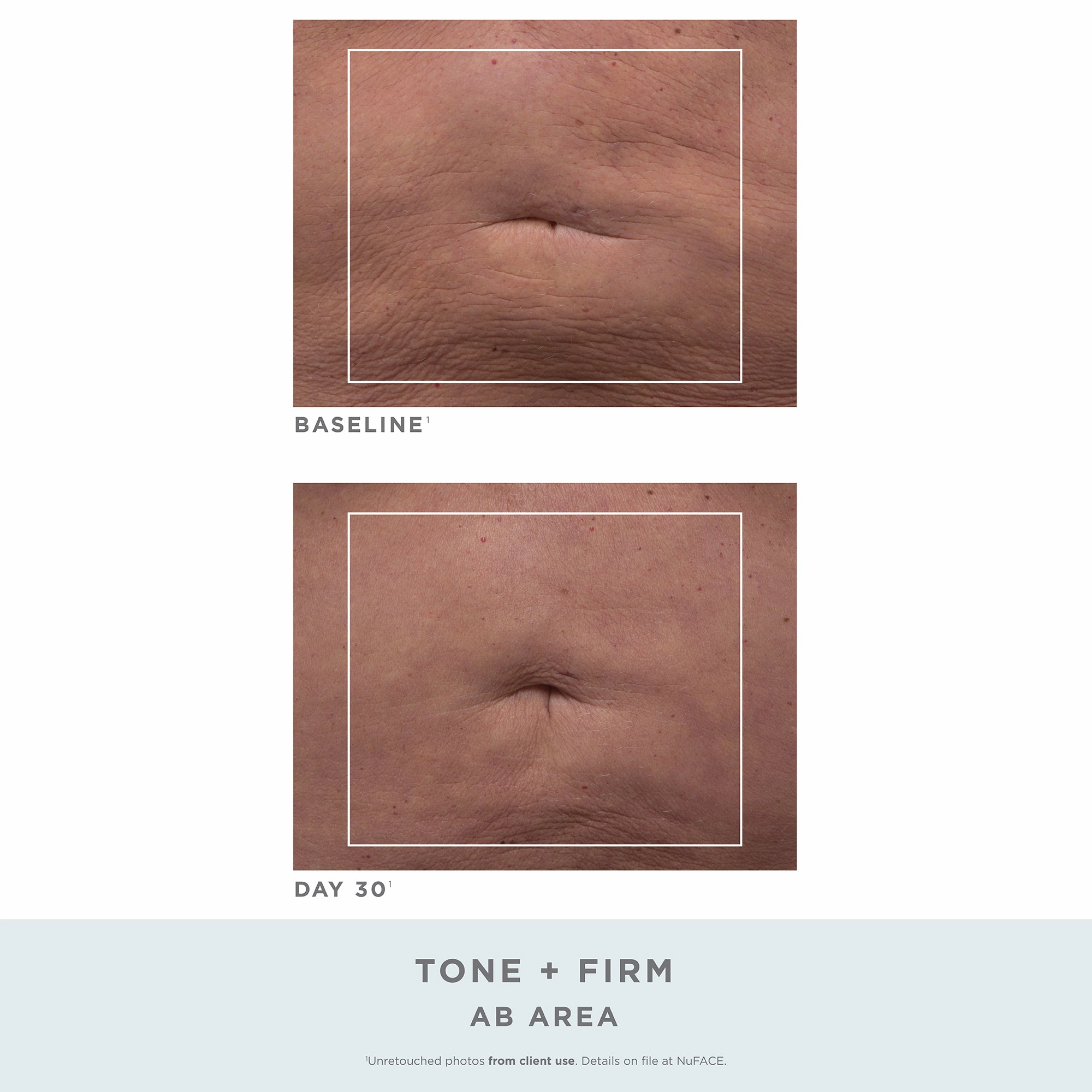 Nuface Nubody Toning And Firming Kit